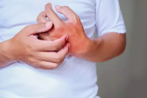 troubles cutanés-démangeaisons-hametum-selomida-peau-cardiospermum